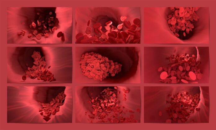 Trombocitopenia trombotica immunitaria indotta da vaccino Pfizer? Nuovo studio pubblicato il 5 agosto 2022